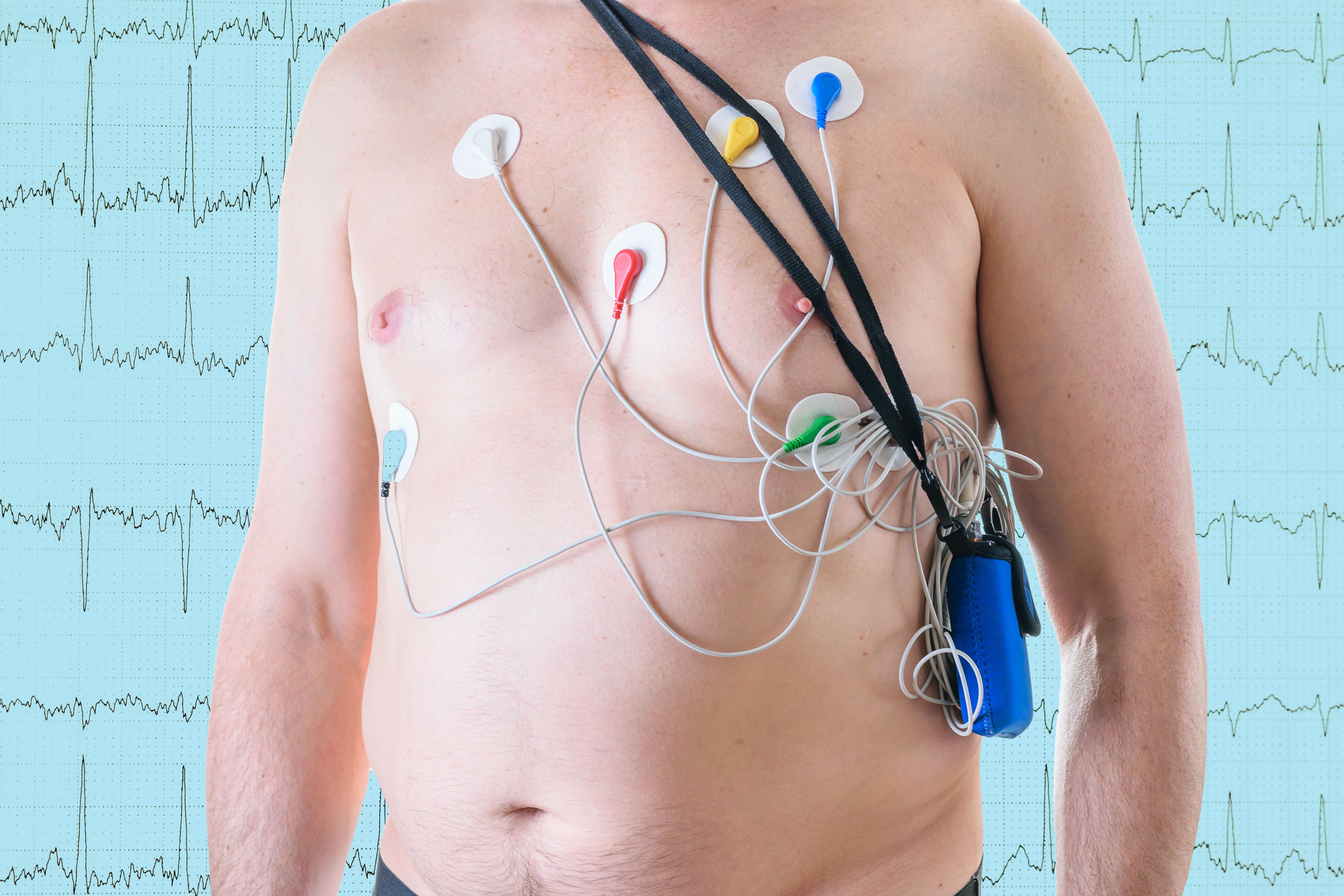 ¿Para qué sirve un Holter? Hombre con el torso desnudo usando un monitor Holter conectado al pecho mediante electrodos, con fondo de un electrocardiograma.
